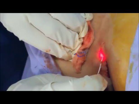Pilonidal sinus Laser Treatment