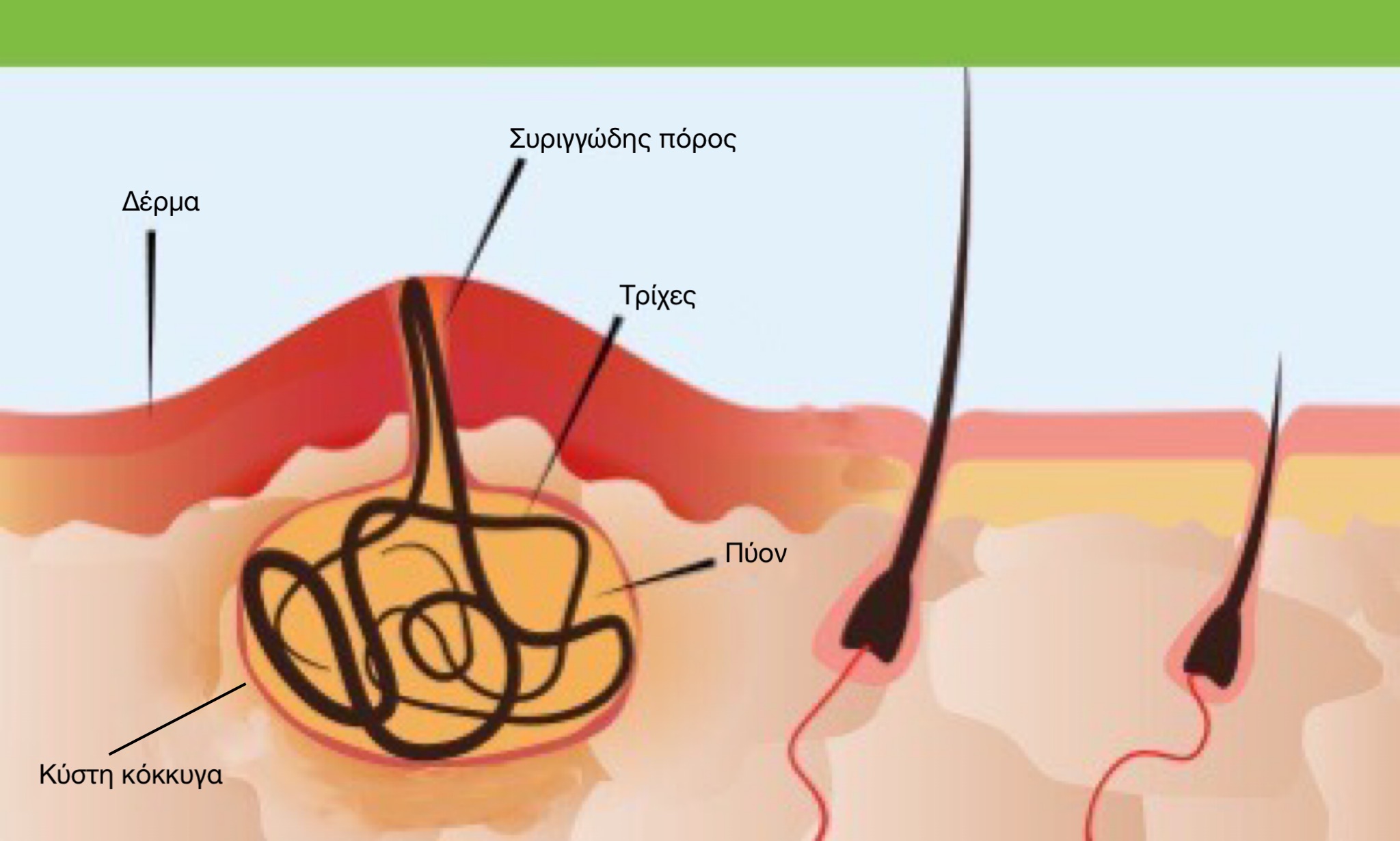 Υποτροπή Κύστης Κόκκυγα – Γιατί Συμβαίνει και Πώς Αποφεύγεται