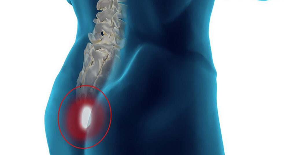 Κύστη Κόκκυγος Laser Αθήνα