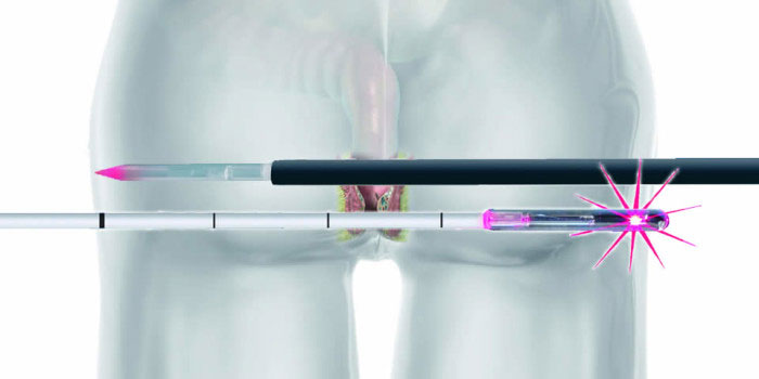 Κύστη Κόκκυγα θεραπεία με Laser - Δρ Δημήτριος Φιλίππου