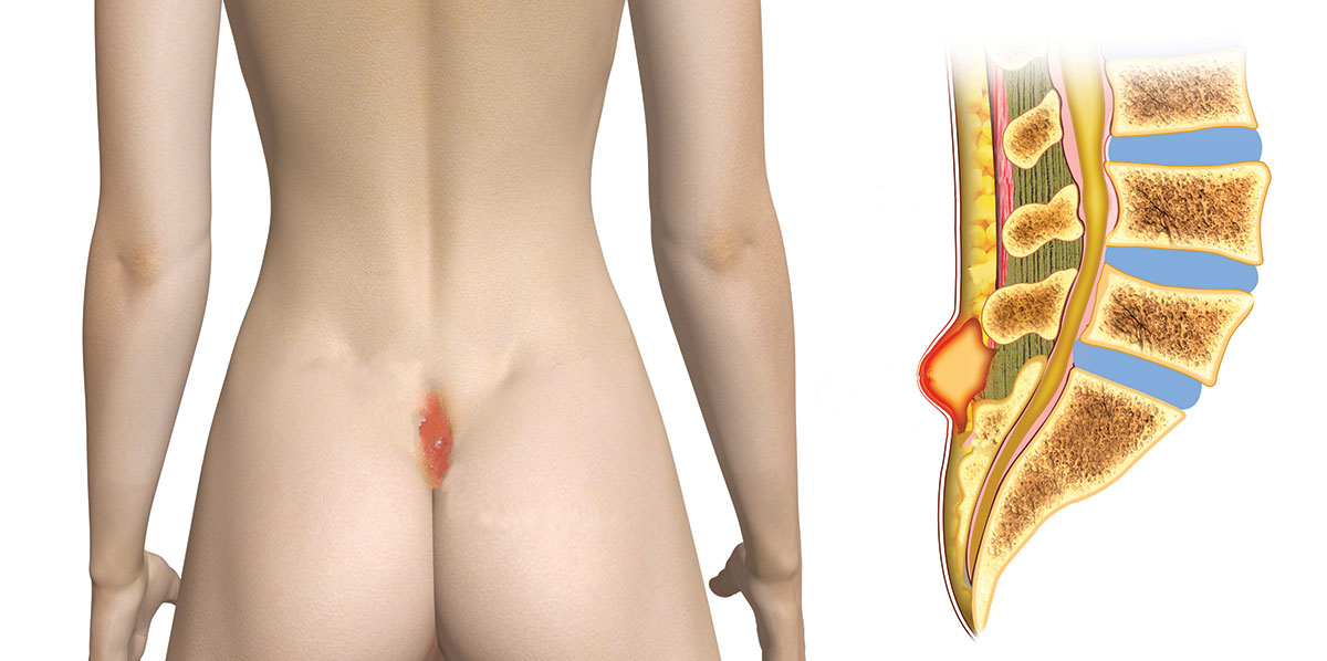 Μετεγχειρητική Φροντίδα Κύστης Κόκκυγα με Laser