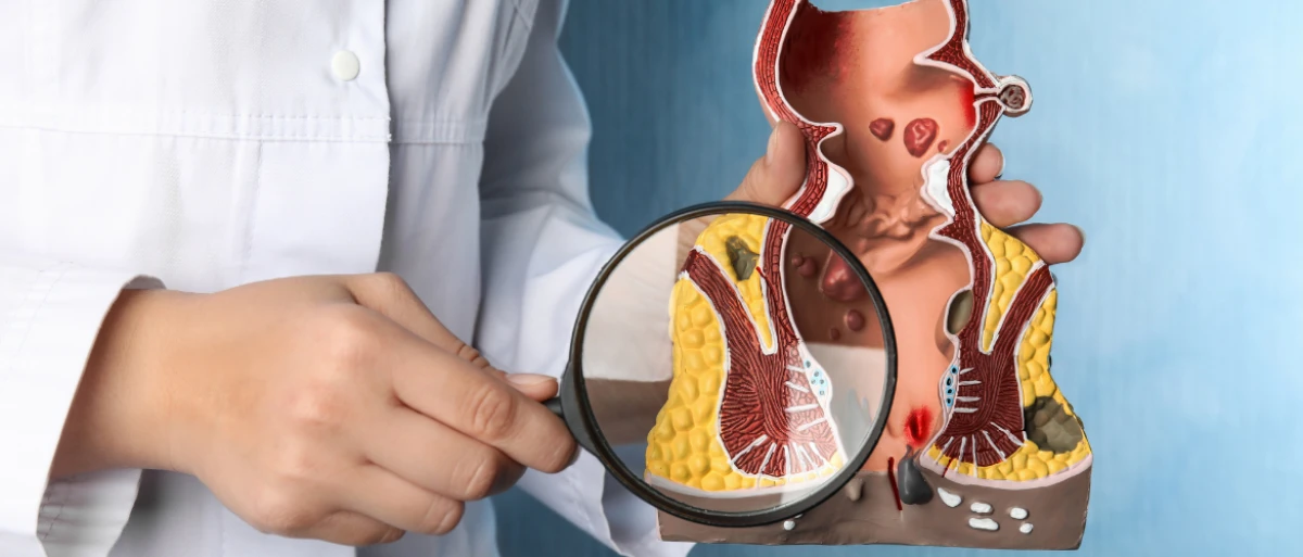 Τι Προκαλεί Αιμορροΐδες