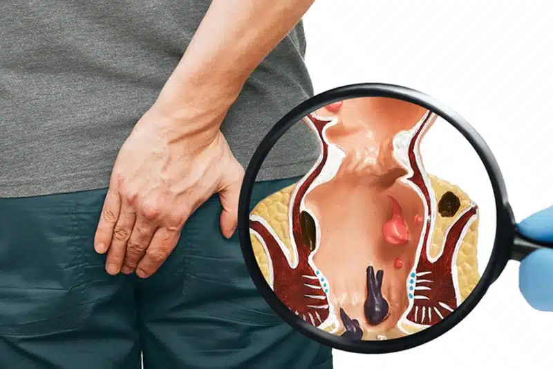 αιμορροΐδες συμπτώματα