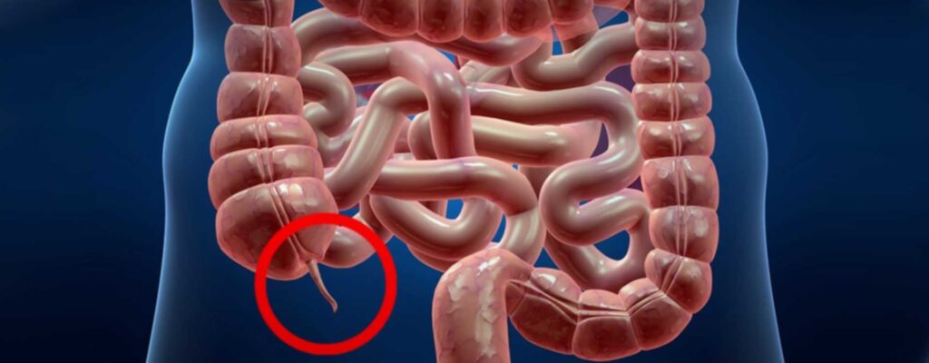 γενικός χειρουργος αθηνα λαπαροσκοπική σκωληκοειδεκτομή