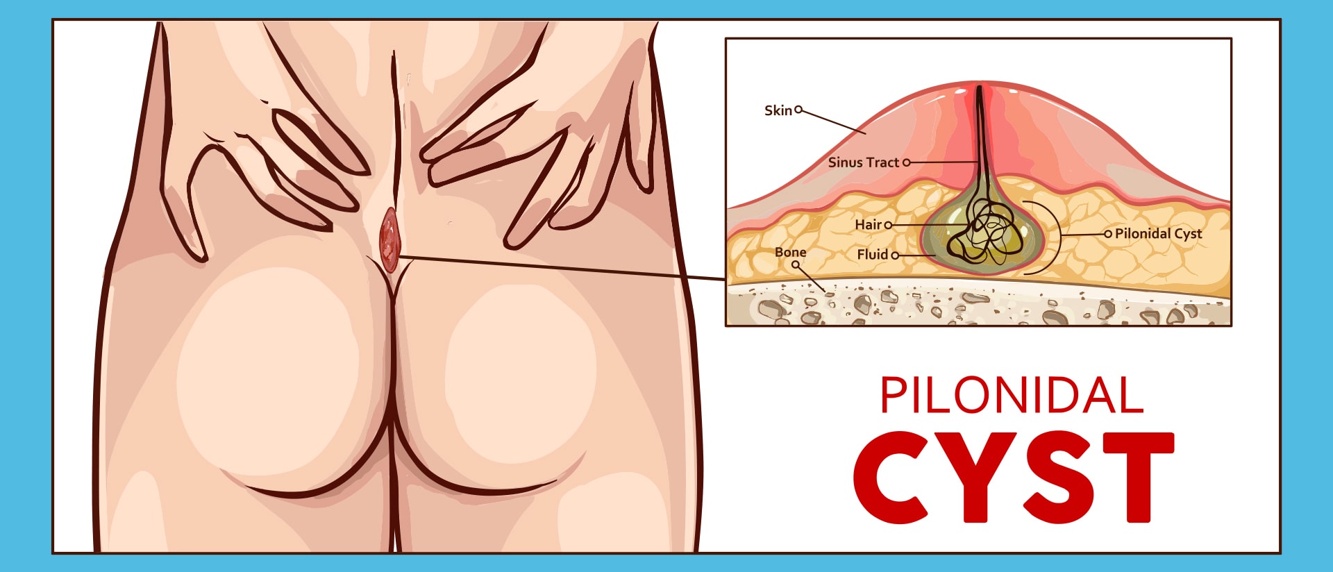 κύστη κόκκυγα συμπτώματα