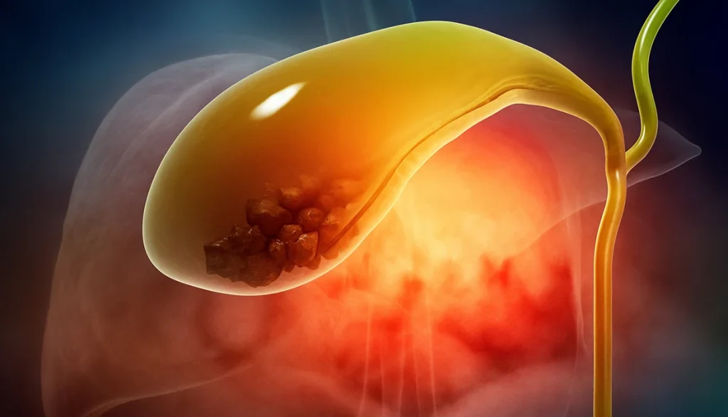 Αίτια δημιουργίας πέτρας στη χολή – Πλήρης οδηγός από χειρουργό στην Αθήνα