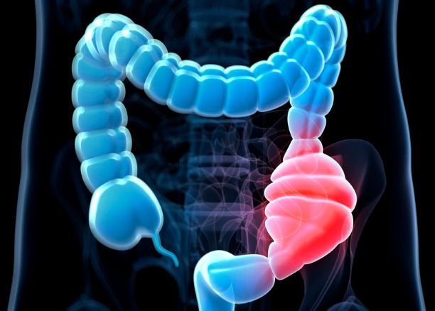 Διατροφή και Απόφραξη Εντέρου