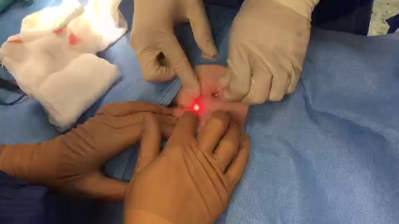 Πόσο διαρκεί η ανάρρωση μετά από Laser Κύστης Κόκκυγα;
