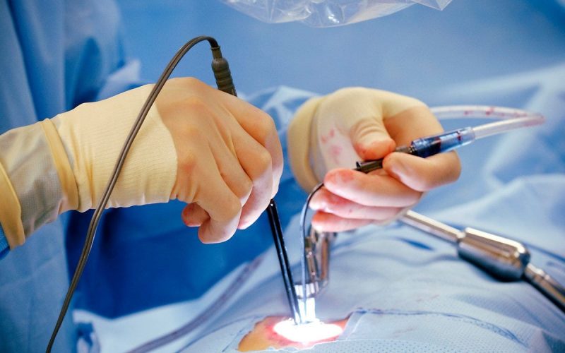 Laser Αιμορροΐδες: Ανώδυνη Θεραπεία & Κόστος